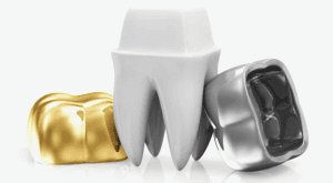 Gold, ceramic and metal dental crowns displayed beside a white model tooth