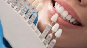 A tooth shade guide held against a patient's teeth to match the colour of a crown