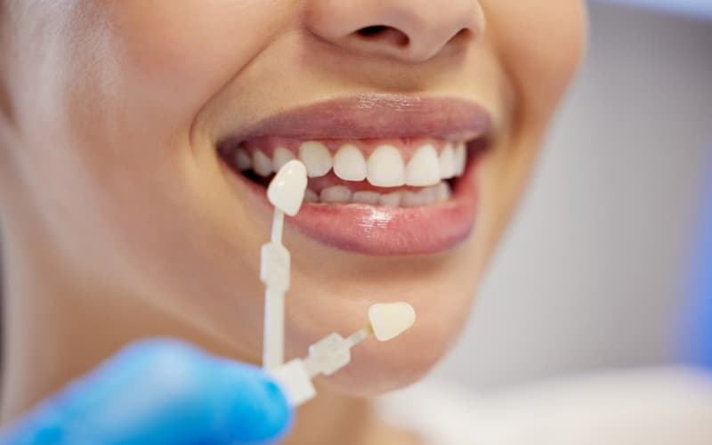 A veneer shade sample held up against a patient's front teeth
