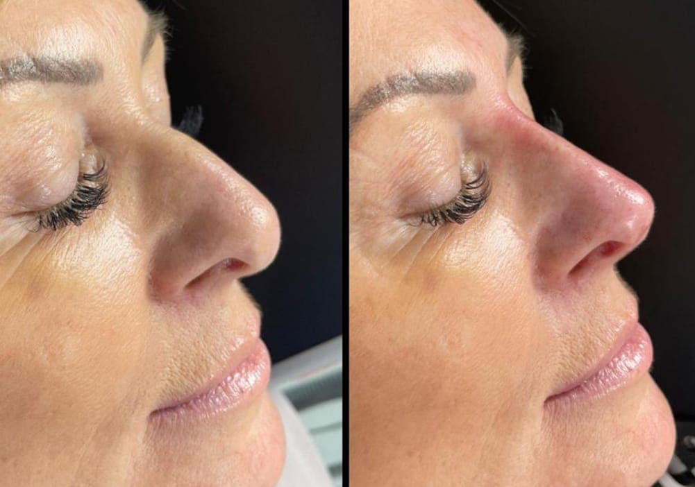 Before and after non-surgical nose reshaping, shown in profile