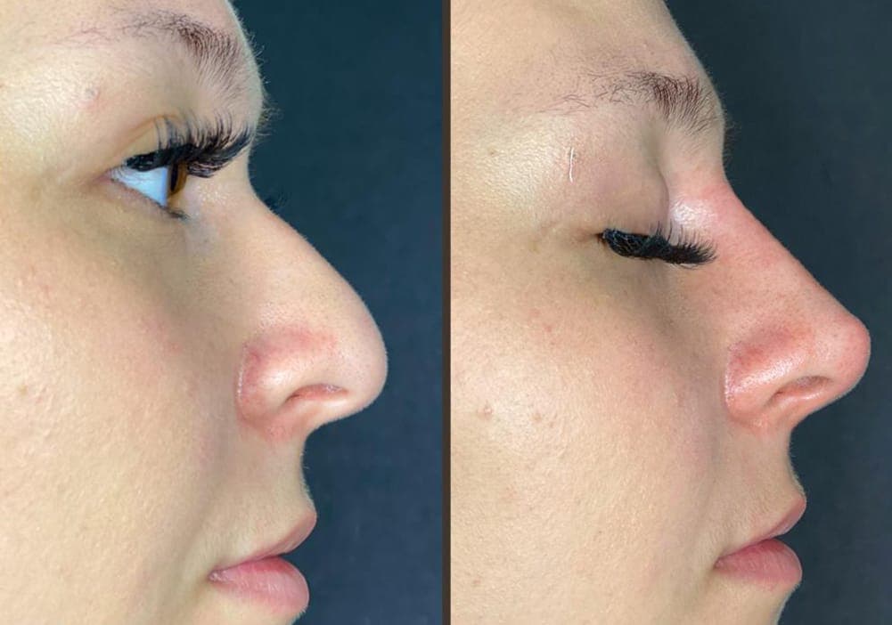 Before and after non-surgical nose reshaping, shown side by side in profile