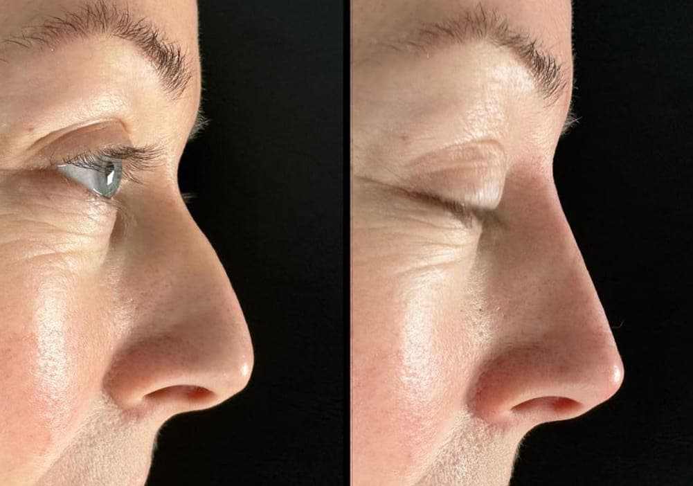 Before and after non-surgical nose reshaping, showing a smoother profile