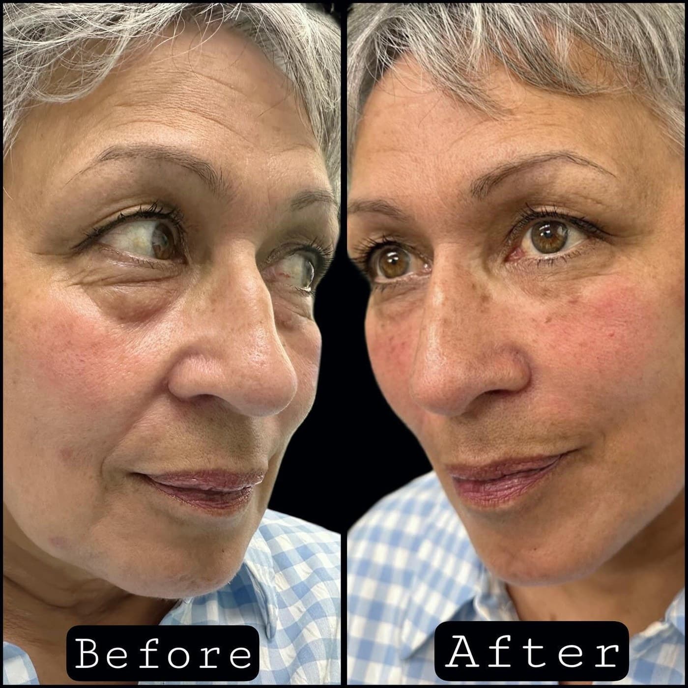 Full face rejuvenation, before and after three-quarter views of an older woman: hollows under the eyes and cheeks restored, the skin looking fresher