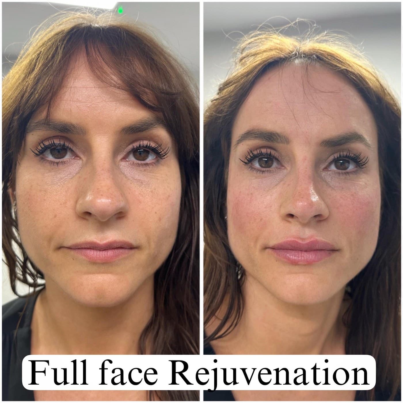 Full face rejuvenation, before and after front views: cheeks and midface lifted, the face looking rested