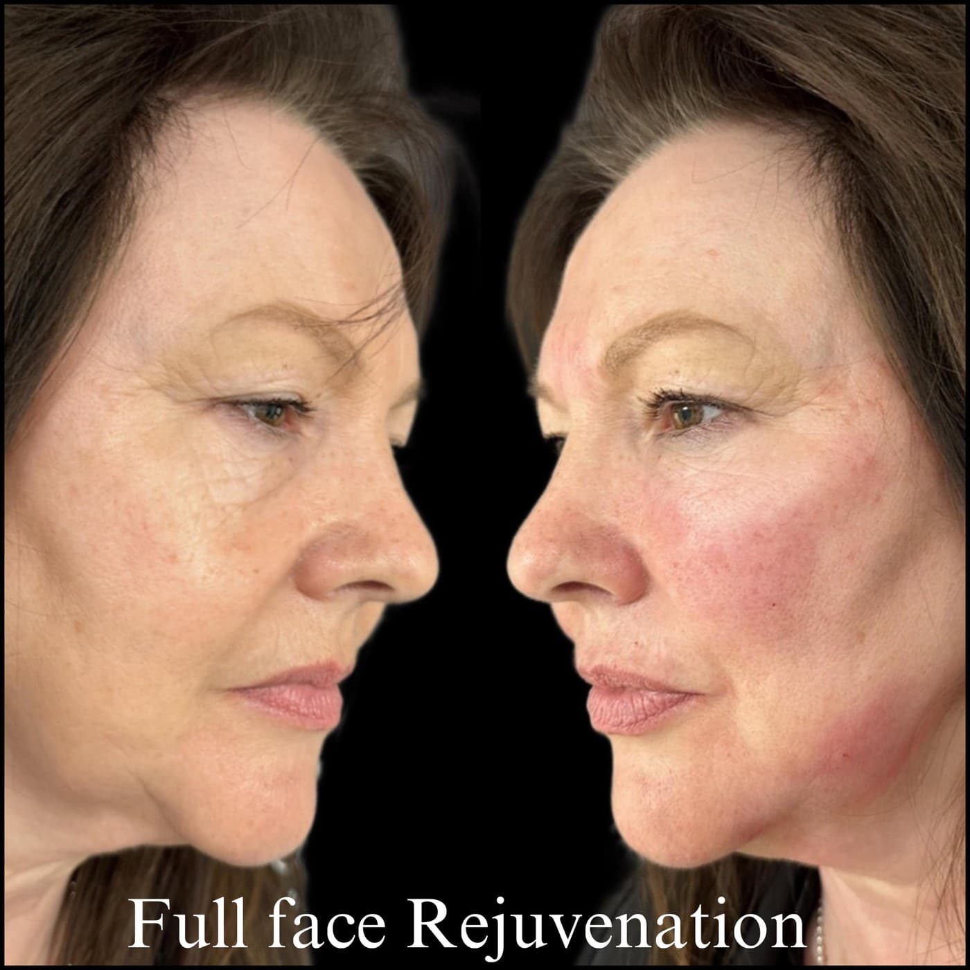 Full face rejuvenation, before and after side profiles of an older woman: volume restored to the cheeks and jawline
