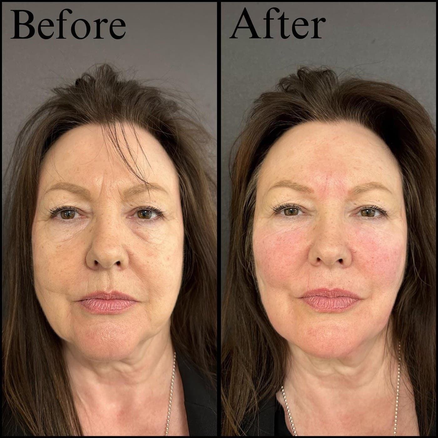 Full face rejuvenation, before and after front views of an older woman: lifted cheeks and softened lines around the mouth