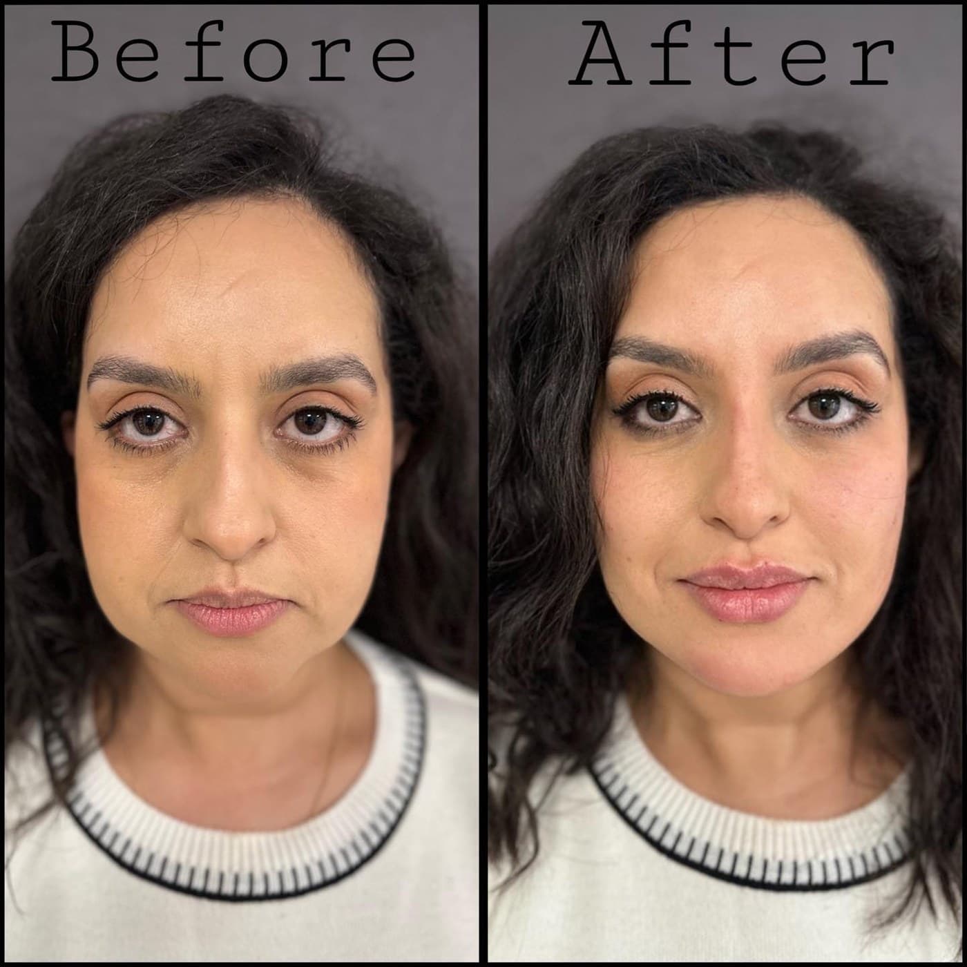 Full face rejuvenation, before and after front views: hollows under the eyes and cheeks filled, the face brighter