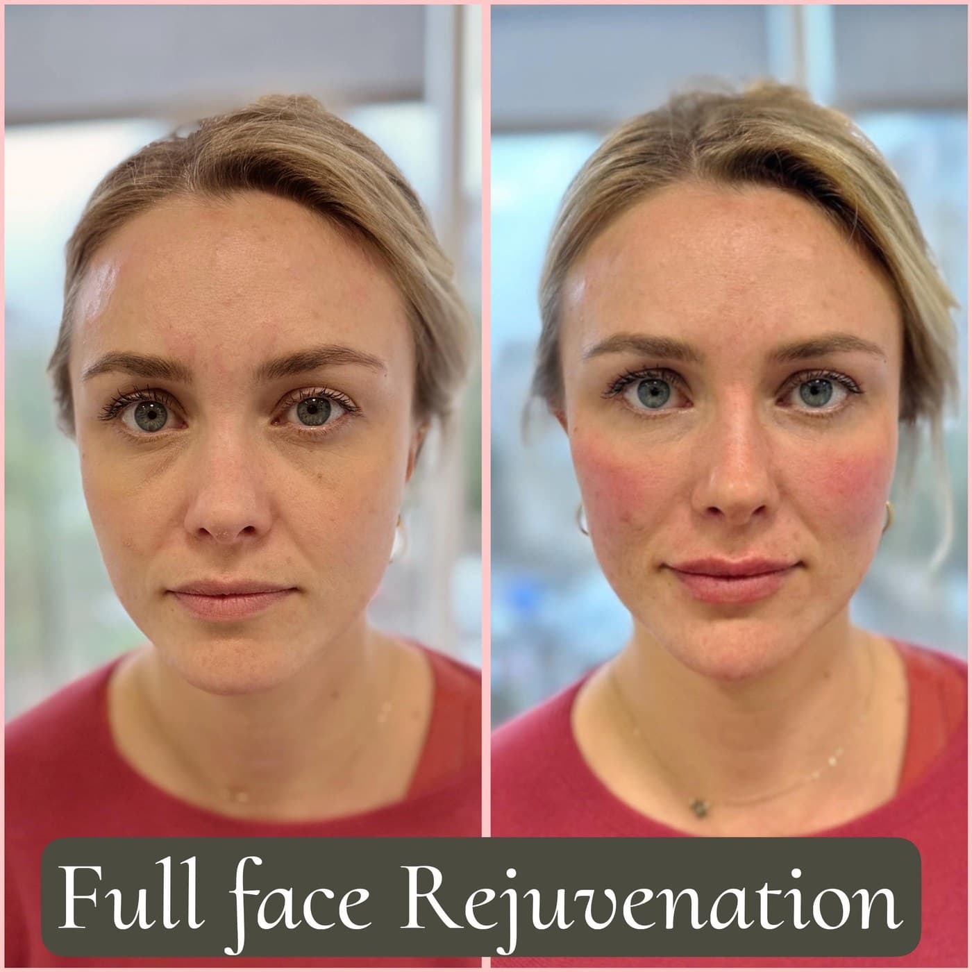 Full face rejuvenation, before and after front views: cheeks lifted and the lower face softened