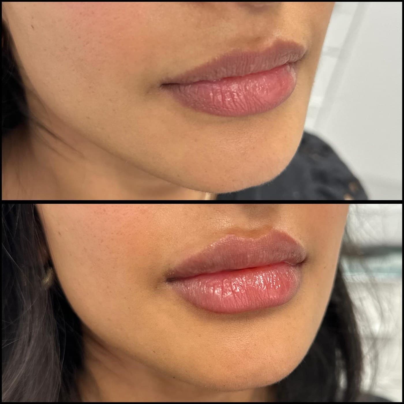 Lip filler, before and after from the side, lower face only: fuller, more defined lips