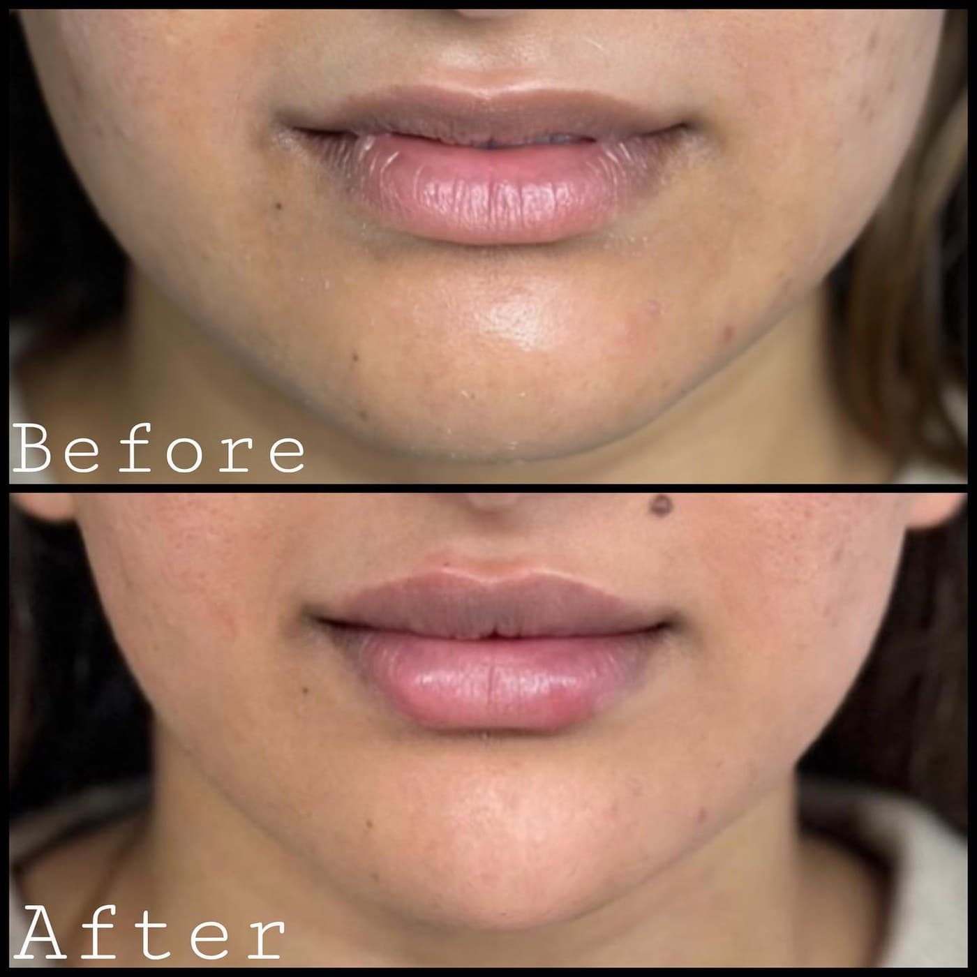Lip filler, before and after of the lower face: fuller lips with natural shape