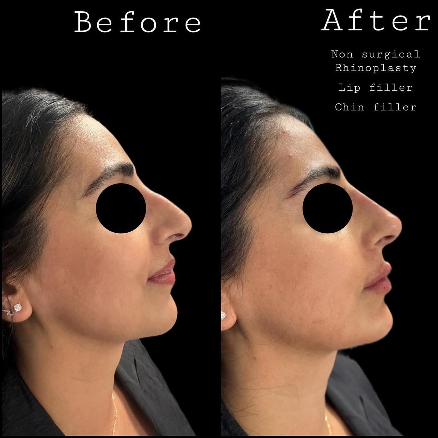 Before and after profile with the eyes masked, labelled non-surgical rhinoplasty, lip filler and chin filler: nose, lips and chin brought into balance