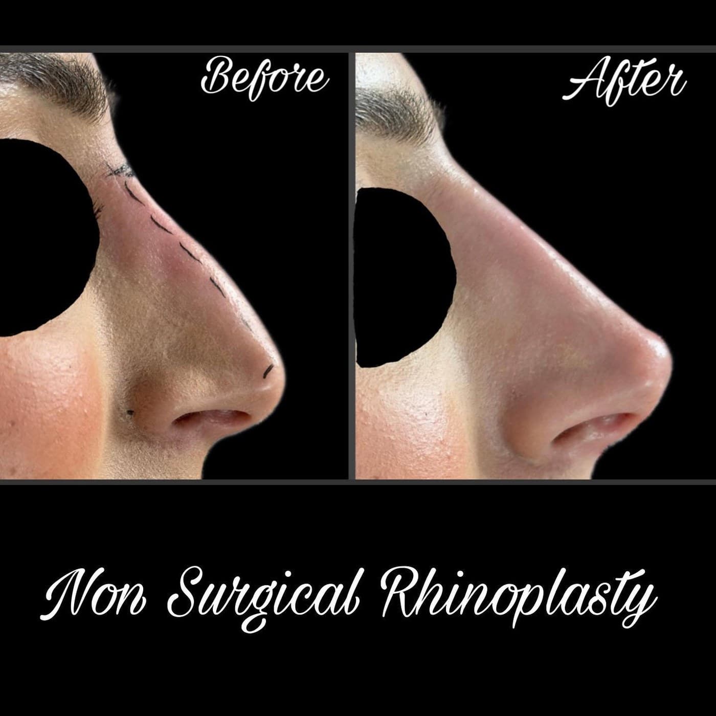 Non-surgical rhinoplasty close-up, before and after with the eyes masked: the bump on the bridge is smoothed into a straight line