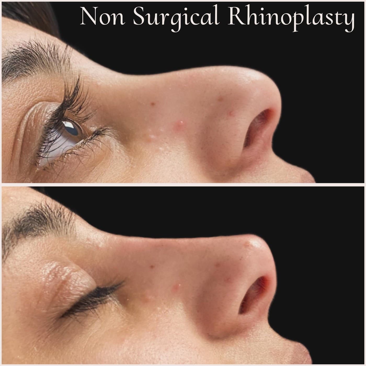 Non-surgical rhinoplasty close-up, before above and after below, eyes closed: the bump on the bridge smoothed