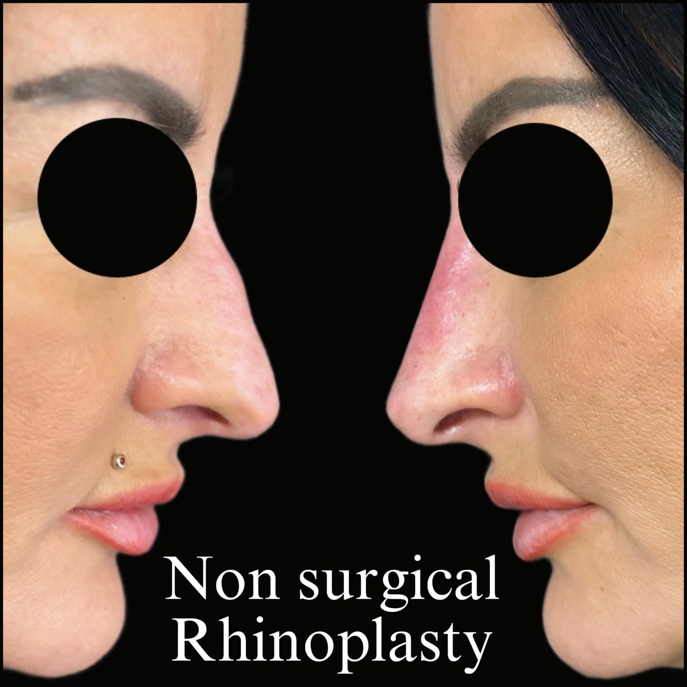 Non-surgical rhinoplasty, before and after side profiles with the eyes masked: the bump on the bridge is disguised and the tip refined