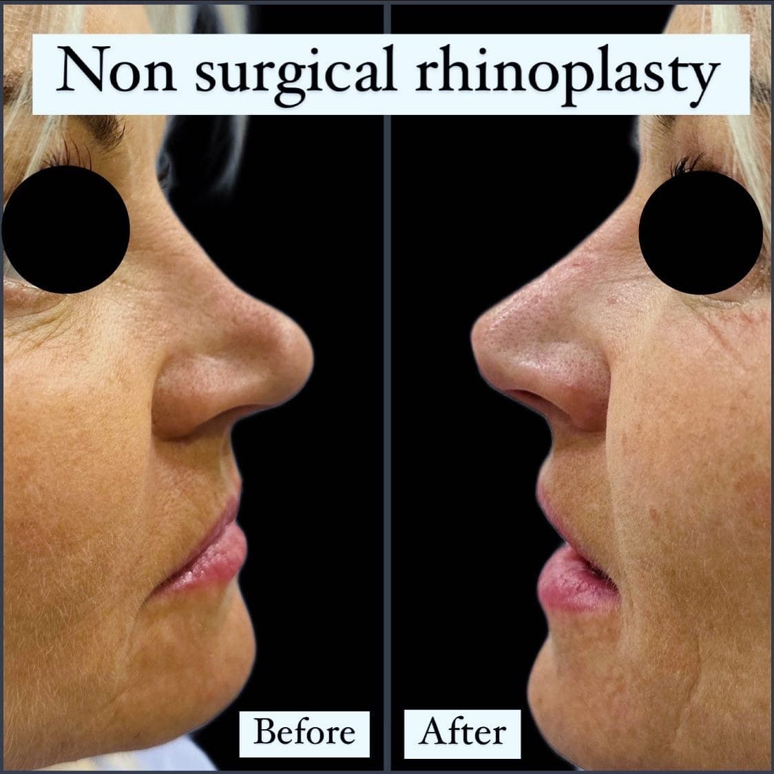 Non-surgical rhinoplasty on an older patient, before and after side profiles with the eyes masked: the drooping tip is lifted