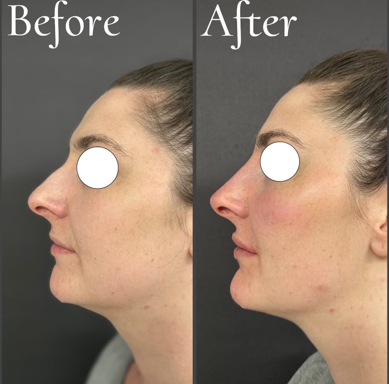 Non-surgical rhinoplasty, before and after side profiles with the eyes masked: a straighter bridge and a lifted tip