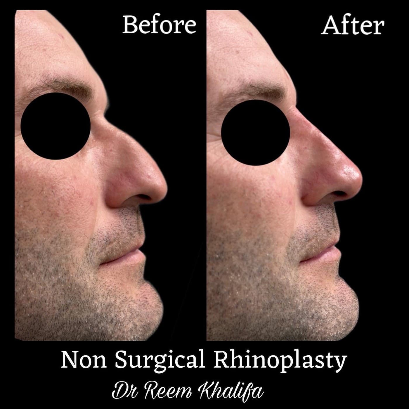 Non-surgical rhinoplasty on a man, before and after side profiles with the eyes masked: the bump on the bridge is smoothed