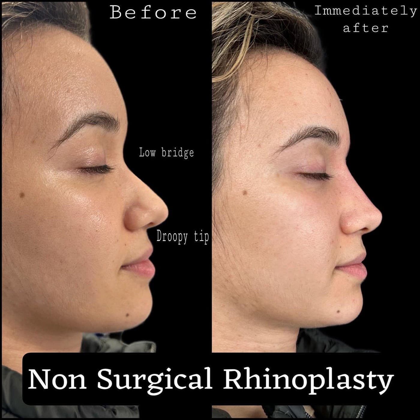 Non-surgical rhinoplasty, before and immediately after, side profile, annotated: a low bridge and a droopy tip, straightened and lifted