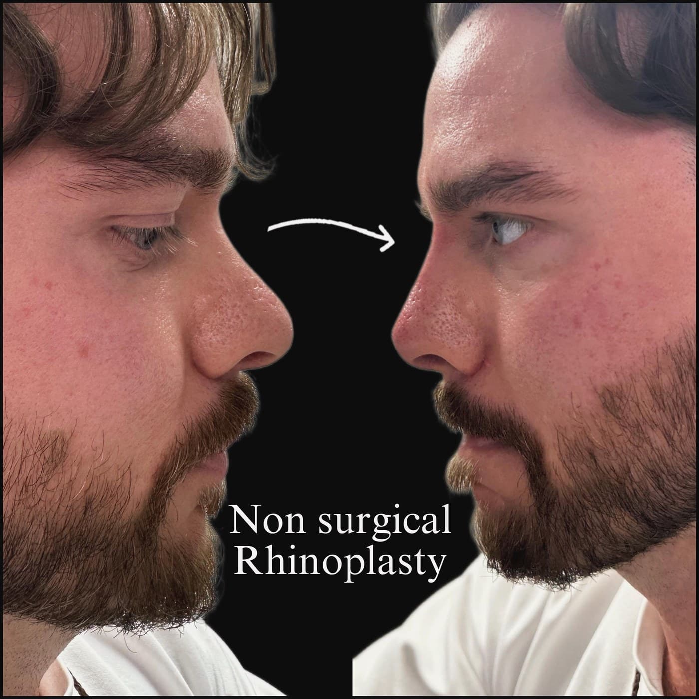 Non-surgical rhinoplasty on a bearded man, before and after side profiles: the bump on the bridge smoothed into a straight line