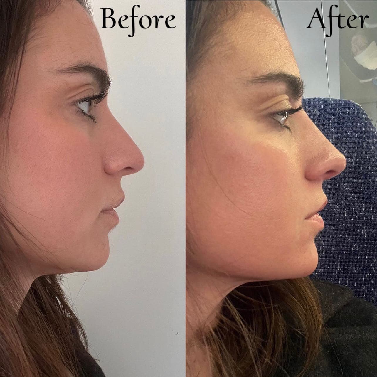 Non-surgical rhinoplasty, before and after side profiles: the tip lifted and the bridge straightened