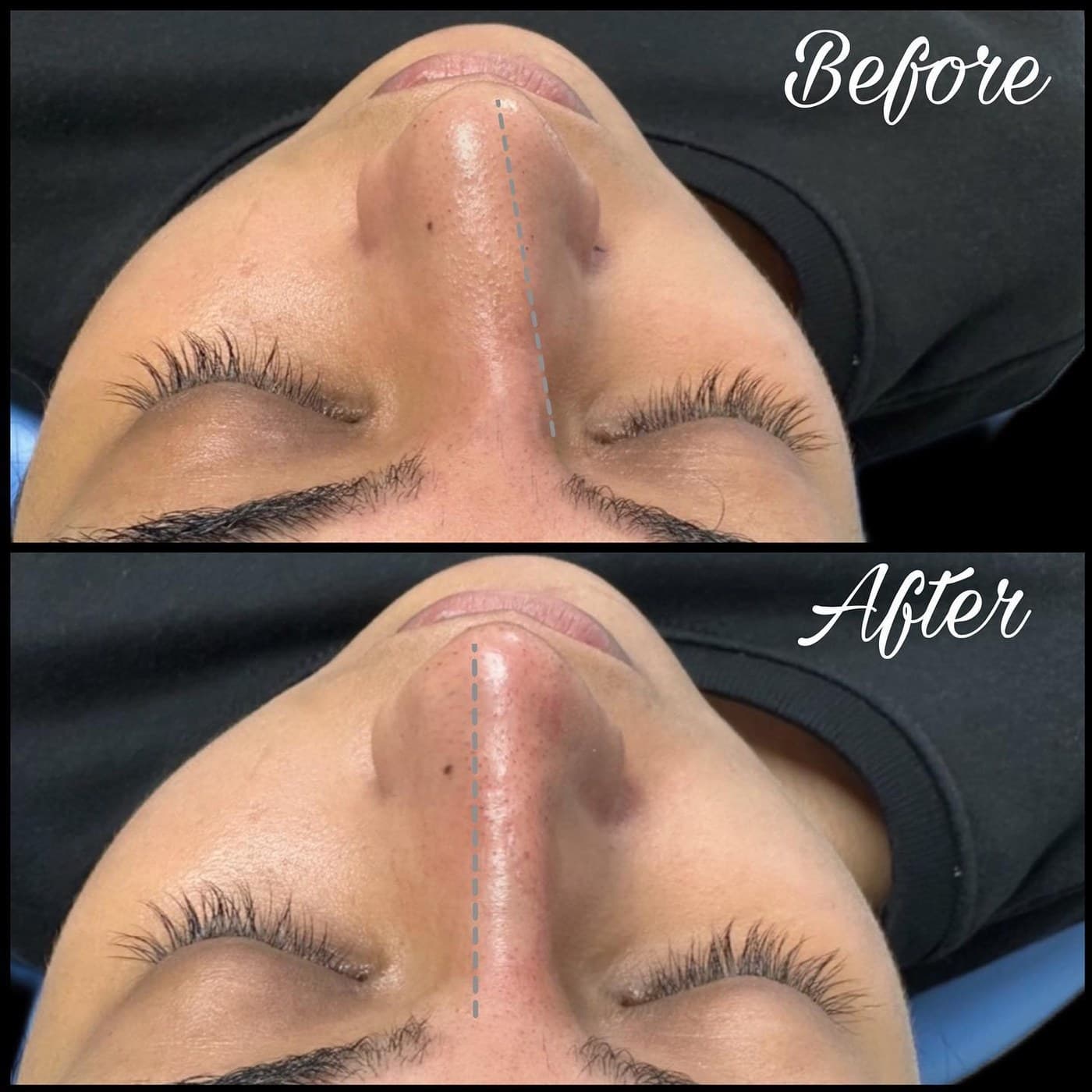 Non-surgical rhinoplasty seen from below, before above and after below, eyes closed: the bridge made straighter and more symmetrical