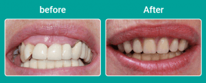 Before and after dental implant treatment, showing a gap in the upper teeth restored with a matching replacement tooth