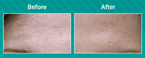 Before and after facial aesthetic treatment, showing forehead lines noticeably softened