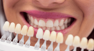 A row of veneer shade samples held against a patient's smile to match the colour