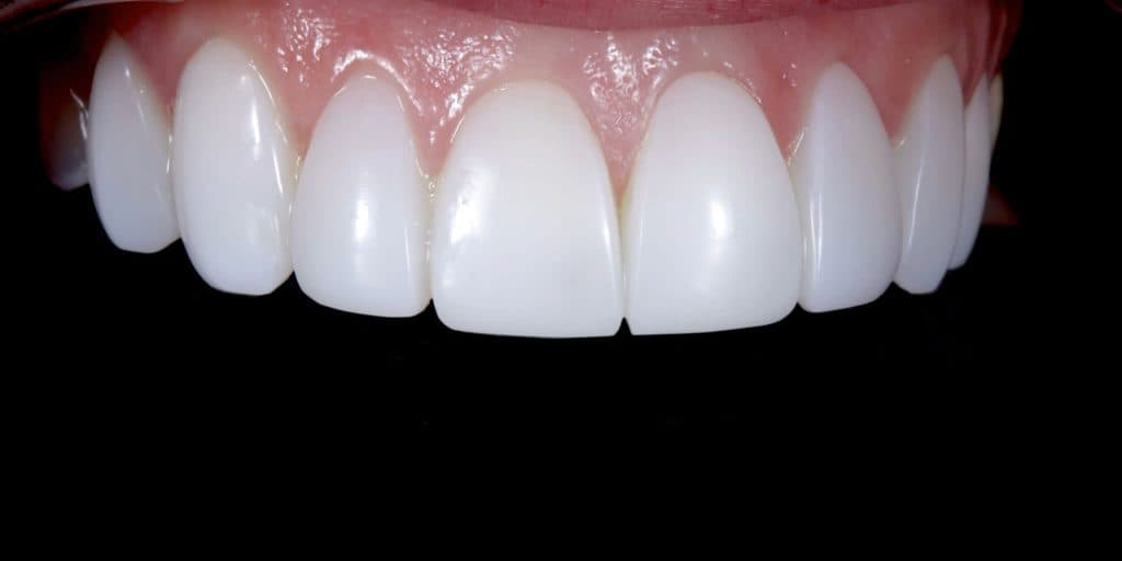 After veneer treatment: upper teeth restored to an even shape and uniform shade
