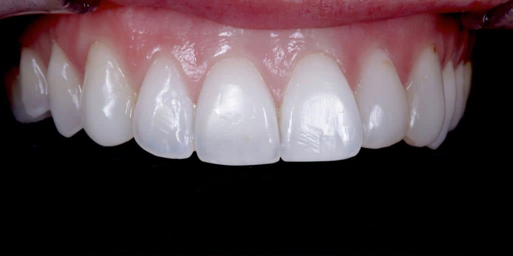Before veneer treatment: upper teeth with uneven edges and visible discolouration