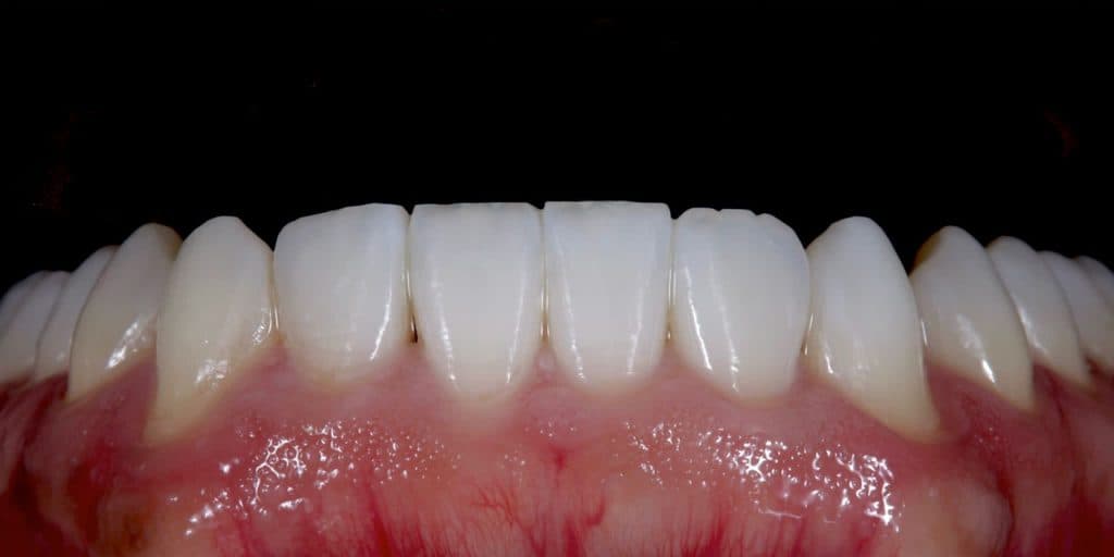 After veneer treatment at the Oakham practice, showing an even upper arch