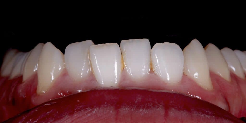 Before veneer treatment at the Oakham practice, showing worn and uneven upper teeth