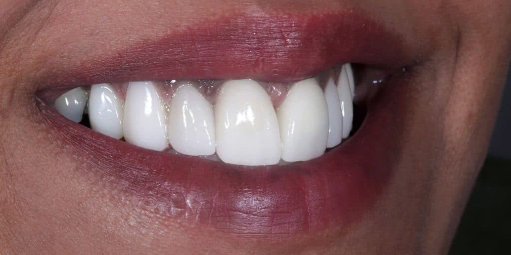 After veneer treatment, showing a brighter and more regular smile
