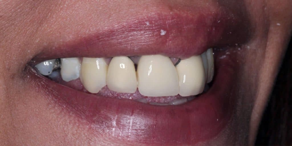 Before veneer treatment, showing discoloured and irregular front teeth