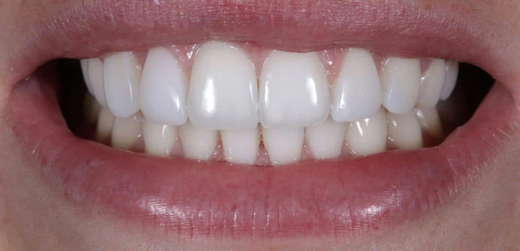 After veneer treatment, showing evenly shaped and shaded front teeth