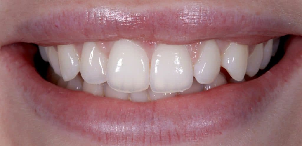 Before veneer treatment, showing chipped and unevenly spaced front teeth