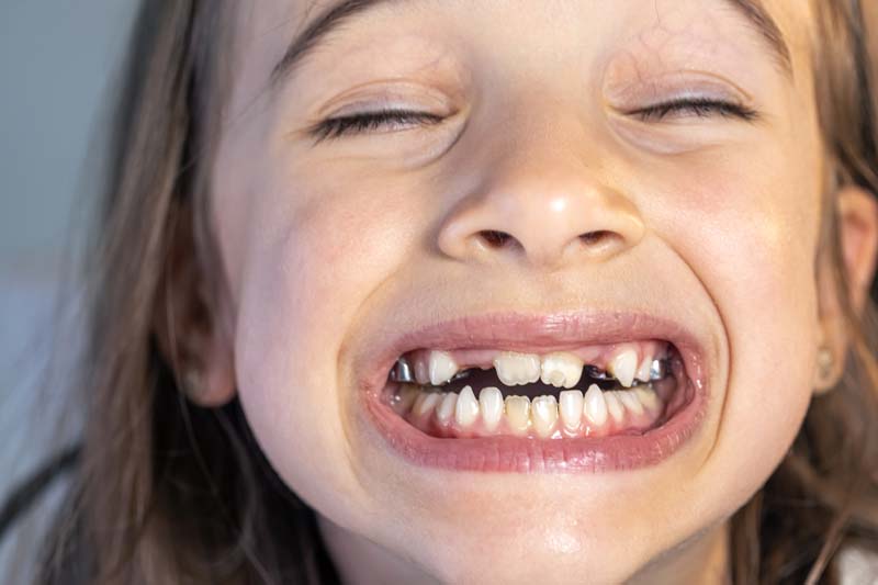 A child smiling widely to show a gap where a baby tooth has come out