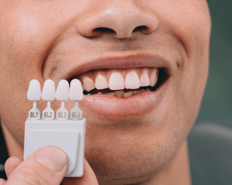 A shade guide held against a man's teeth to match the colour before treatment