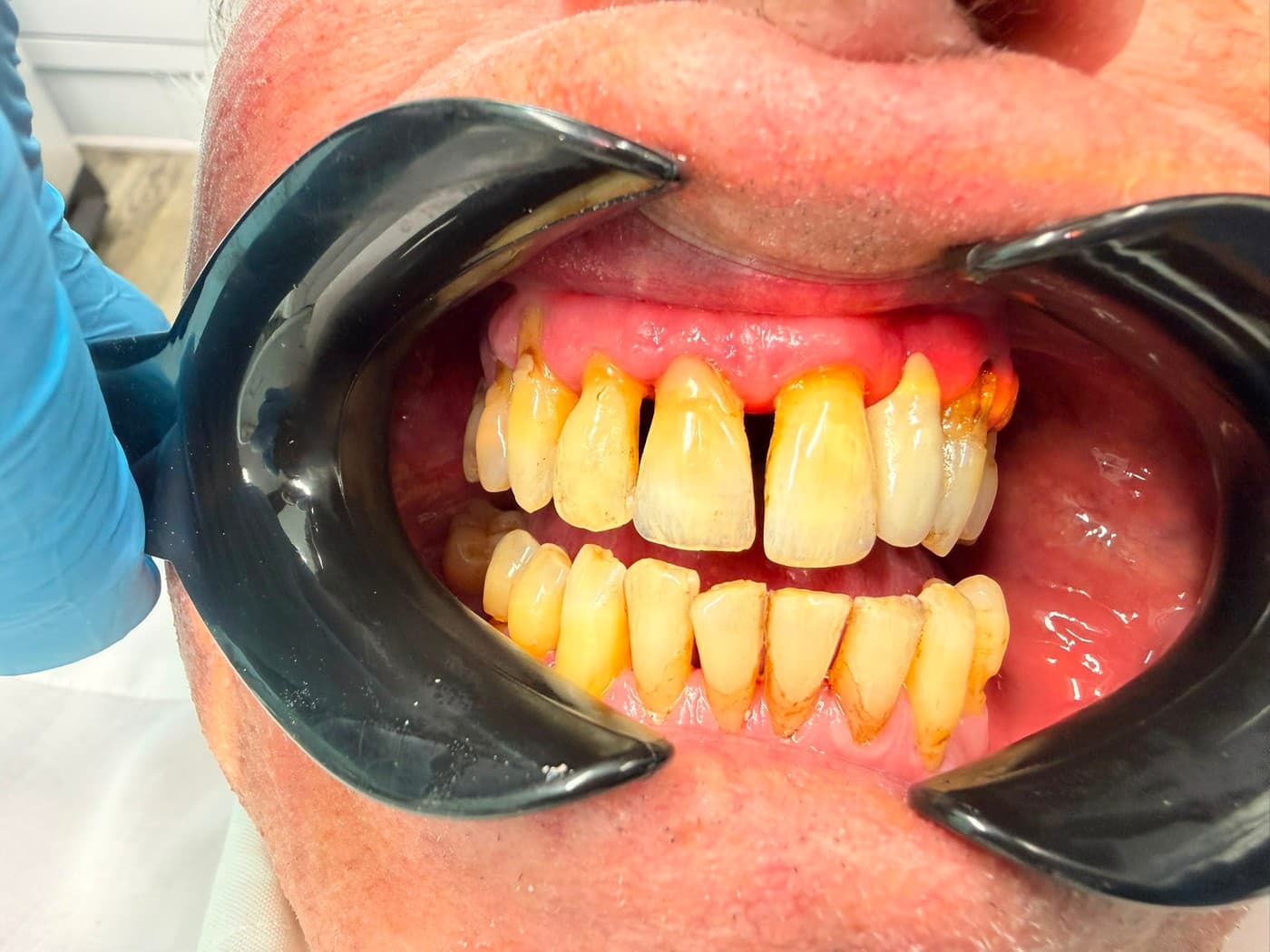 Before treatment, from an angle: the same staining along the gum line, with the retractor held to one side
