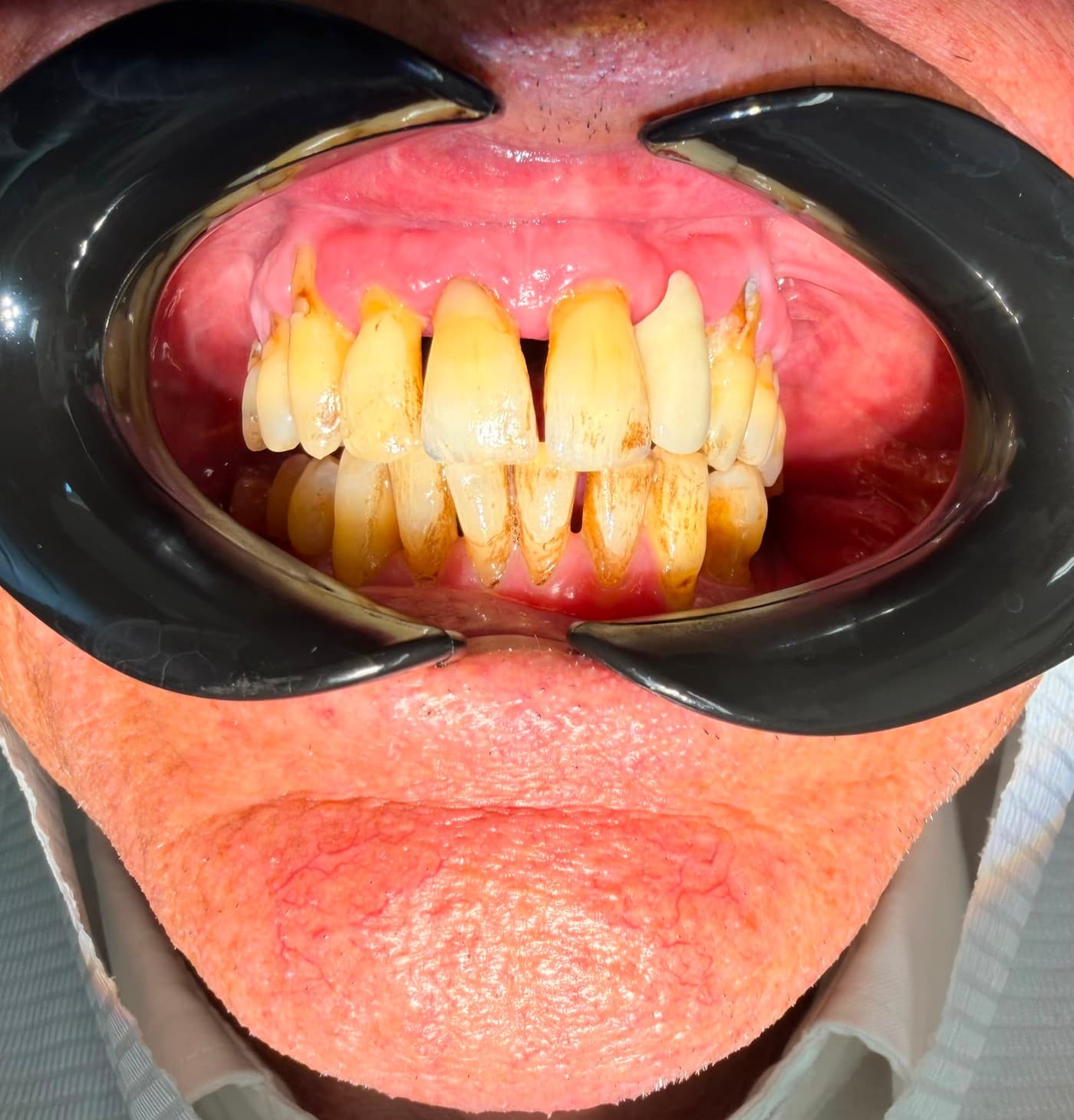 Before treatment: the front teeth held apart by a retractor, with heavy brown and orange staining banding the necks of the upper and lower teeth and filling the gaps between them