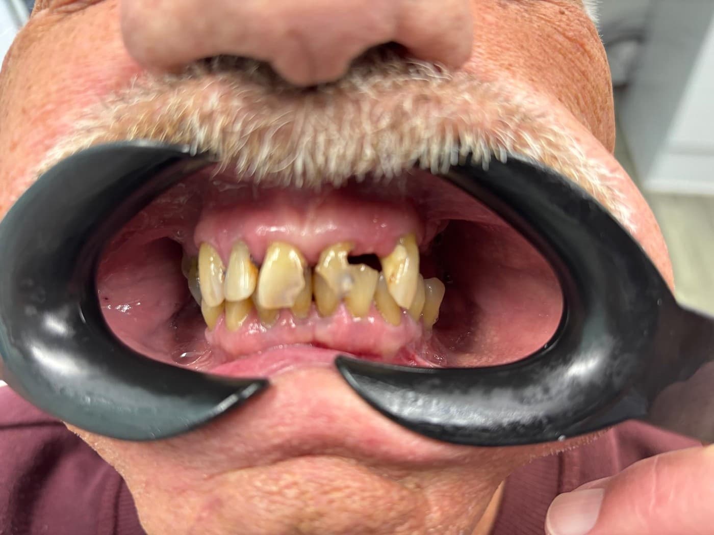 Before the bridge, closer: the upper front teeth worn and stained, with dark marks at the gum line, the broken tooth and the gap beside it