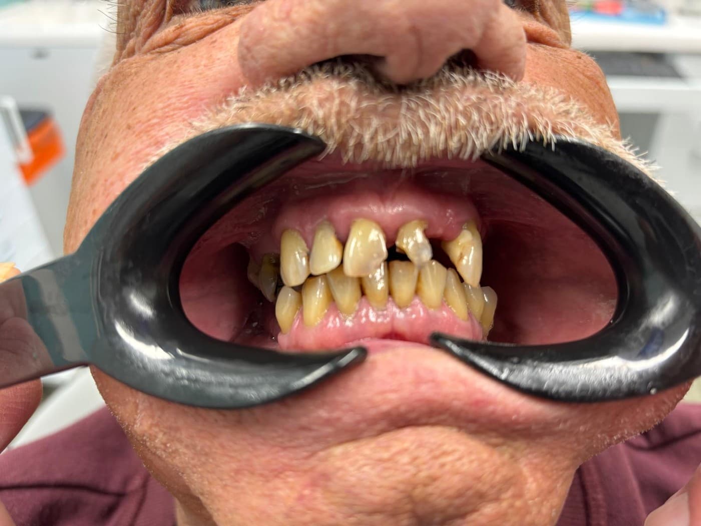 Before the bridge: the patient’s mouth held open with a cheek retractor, showing worn, discoloured upper teeth of uneven length, a broken tooth beside a gap near the centre, and the lower front teeth beneath