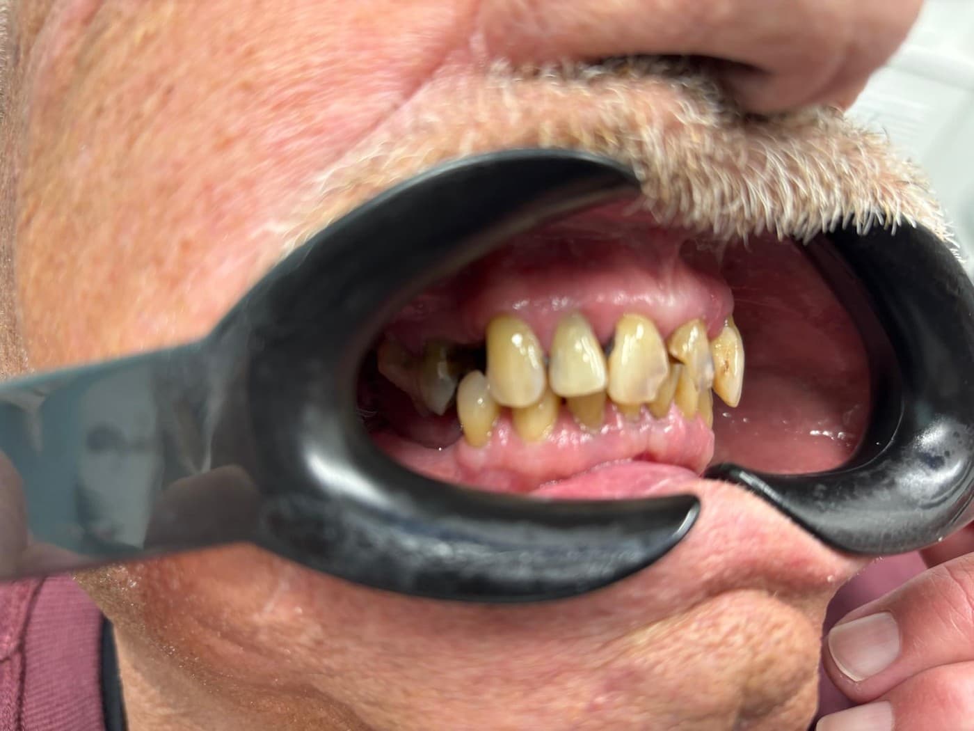 Before the bridge, from one side: the upper teeth sitting at different angles and lengths, with gaps further back