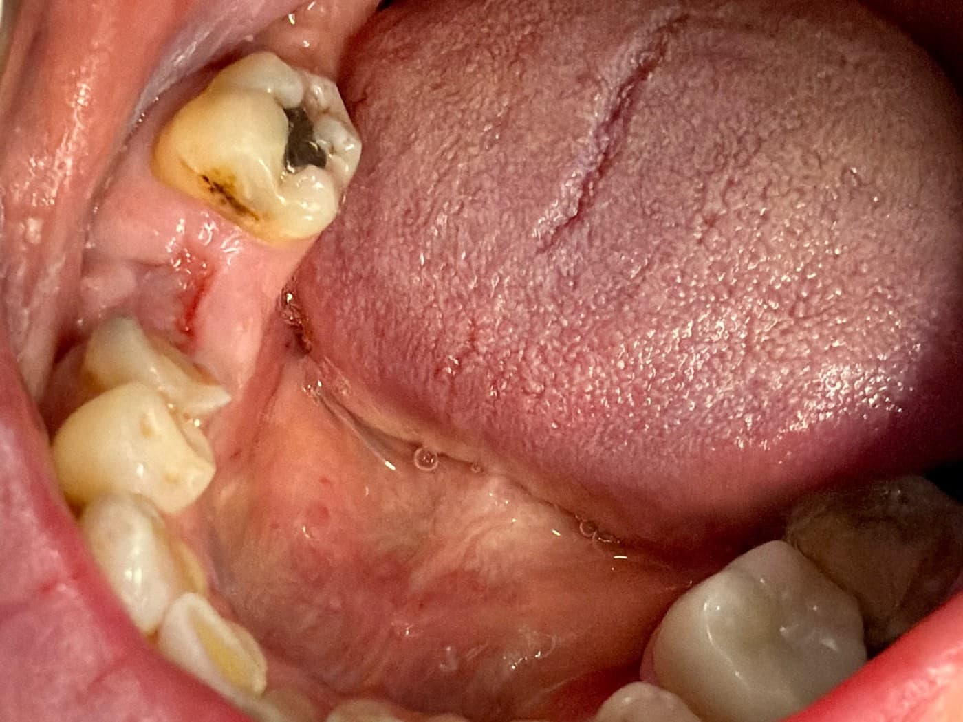 Before the implant: the gap in the gum where a back tooth is missing, between a tooth with a dark filling and the teeth in front of it, with the tongue beside it