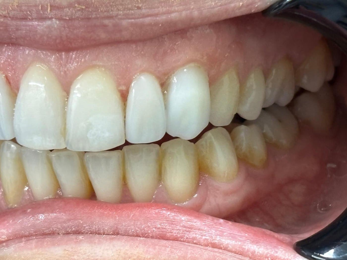 After treatment, other side: the upper teeth now match in length and shade