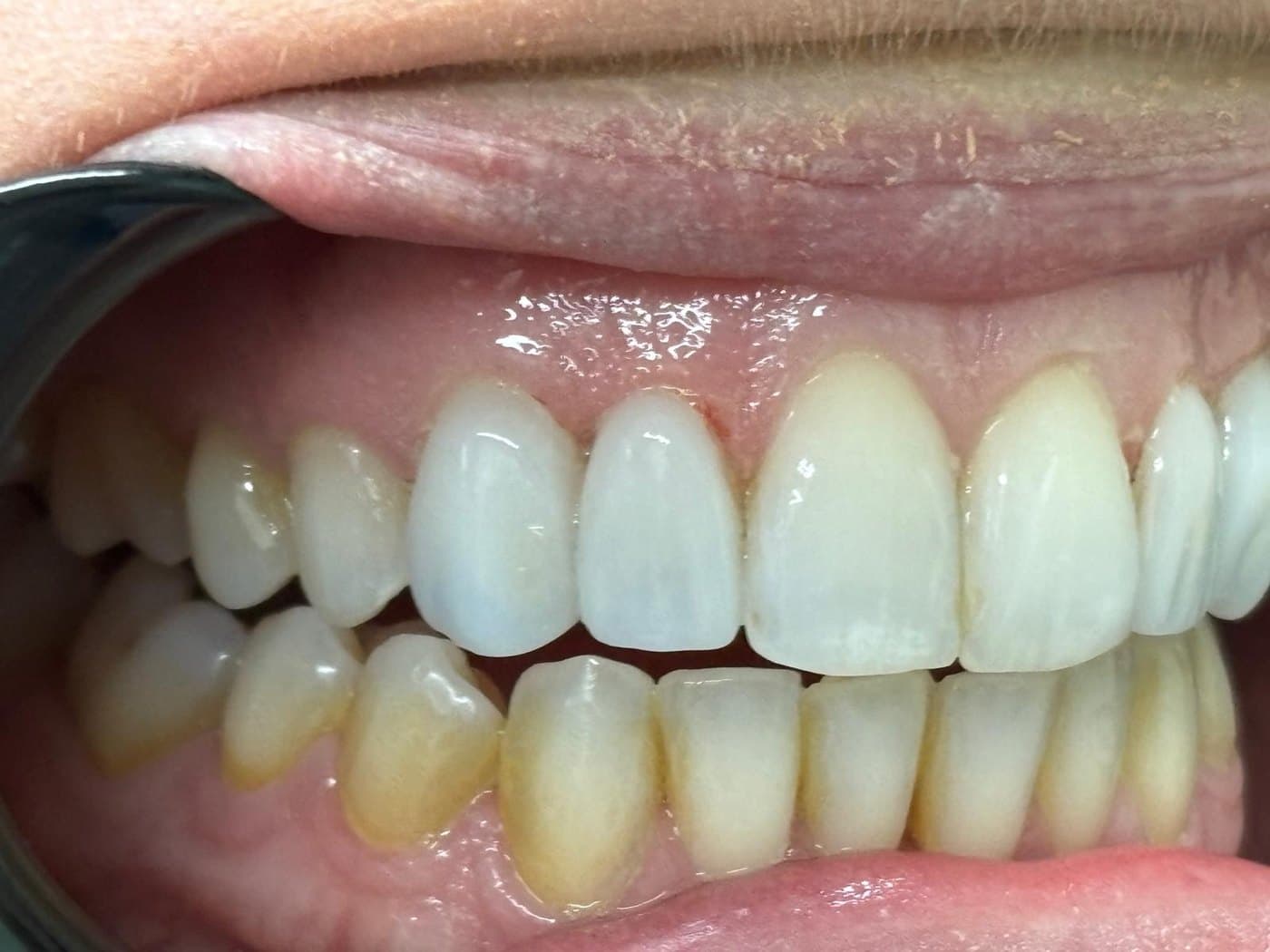 After treatment: no-prep veneers have lengthened the teeth so the incisal edges run level with the front two