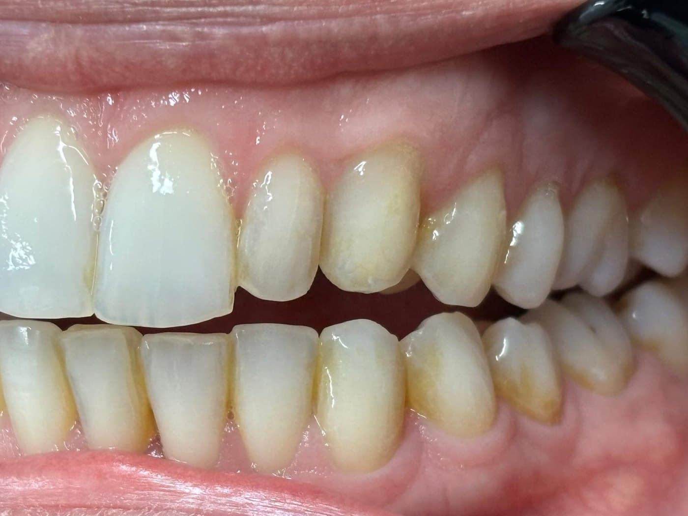 Before treatment, other side: the same stepped incisal edge where the teeth are shorter than the patient’s front two