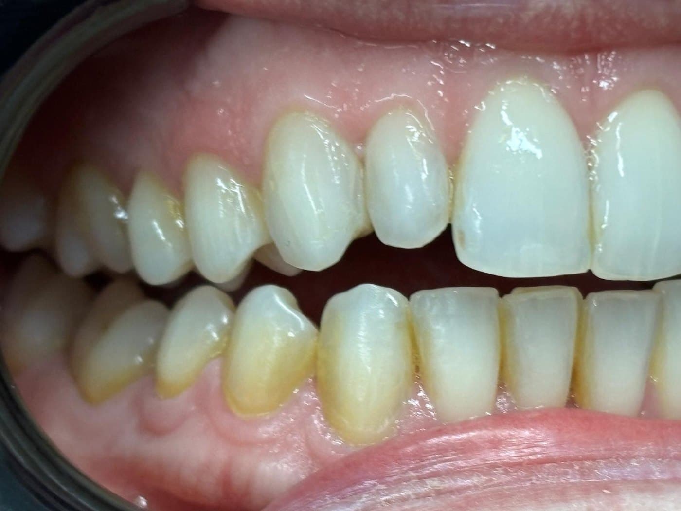 Before treatment: the upper teeth beside the central incisor sit noticeably shorter, creating a stepped edge, with discolouration towards the gum line
