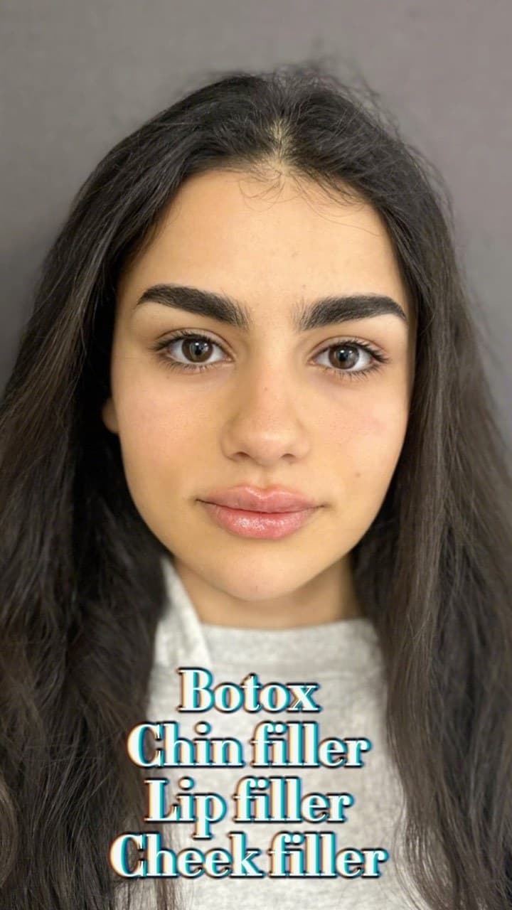 A young woman after combination treatment, front view, labelled Botox, chin filler, lip filler and cheek filler