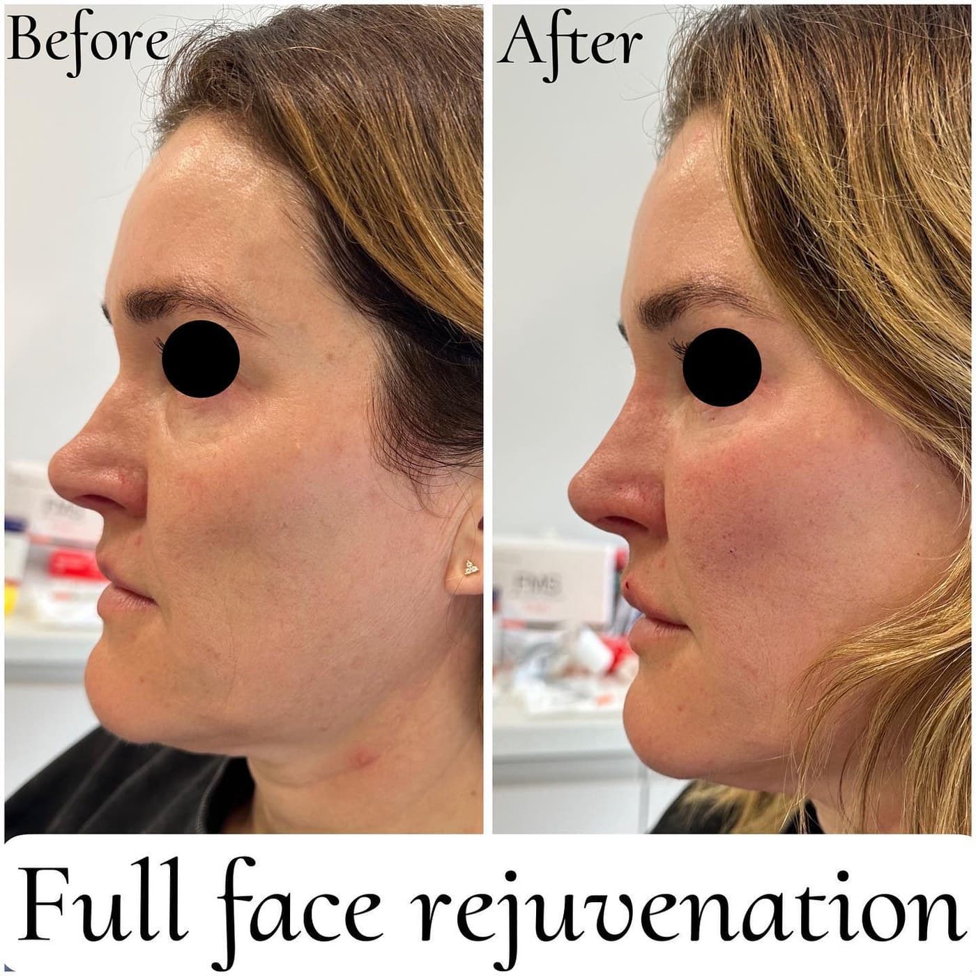 Full face rejuvenation with fillers, before and after three-quarter views with the eyes masked: restored cheek volume and a softer jawline